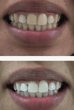 Load image into Gallery viewer, SNOW TEETH WHITENING™ SYSTÈME À DOMICILE [KIT TOUT-EN-UN]
